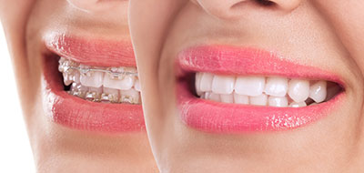 El Cajon Dentistry | Veneers, Dental Bridges and Oral Exams