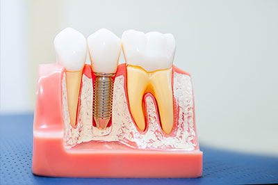 El Cajon Dentistry | Dental Bridges, Periodontal Treatment and Invisalign reg 